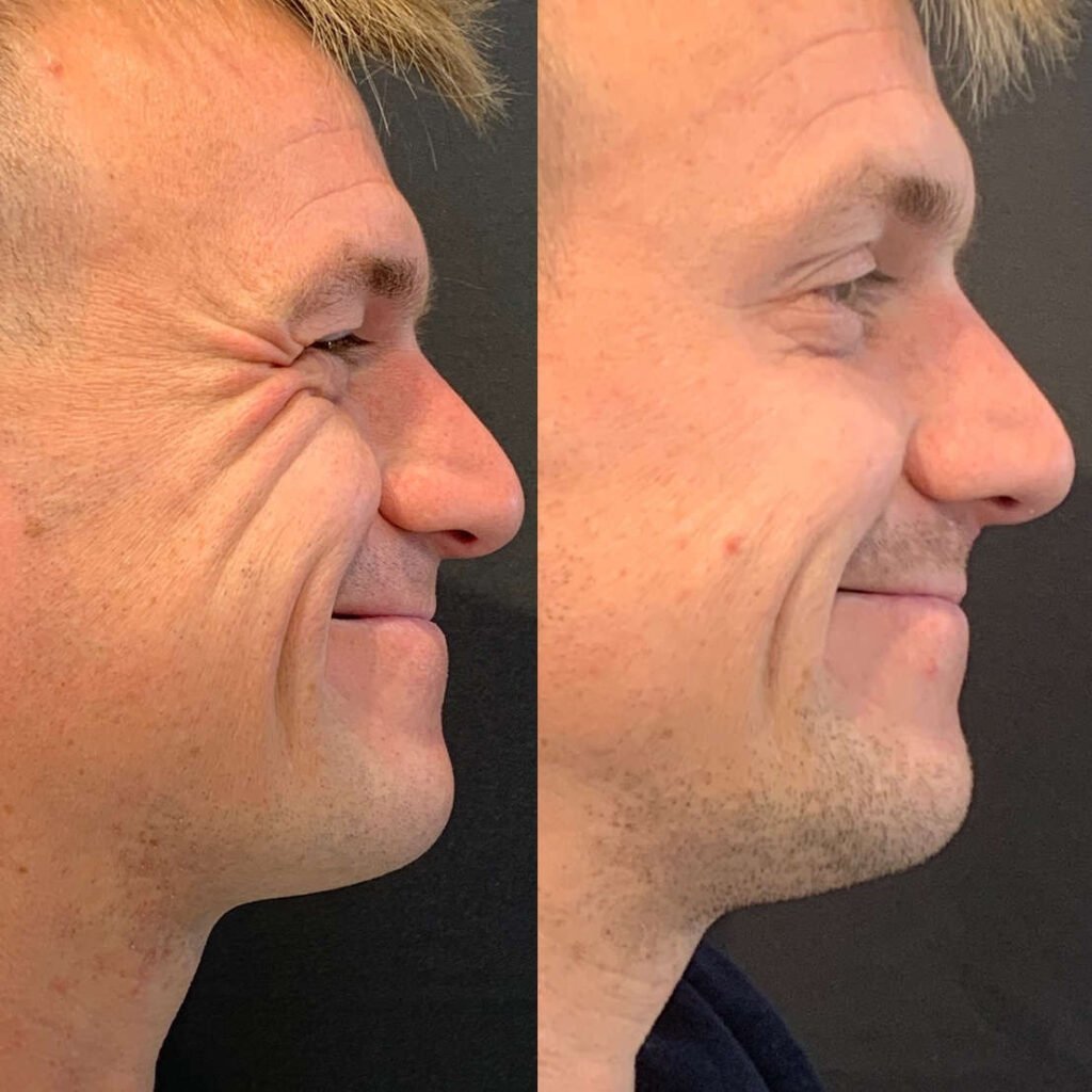Anti-Wrinkle Injections: What Actually Happens Before, During and After Treatment
